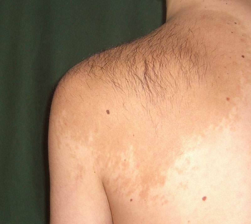 The Mysterious Meanings Behind Different Types of Birthmarks.