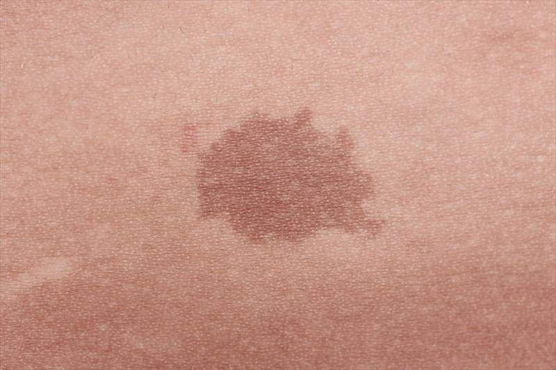 Uncovering the Hidden Symbology of Birthmarks